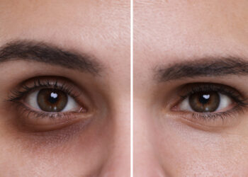 augenringe in 1 minute weg