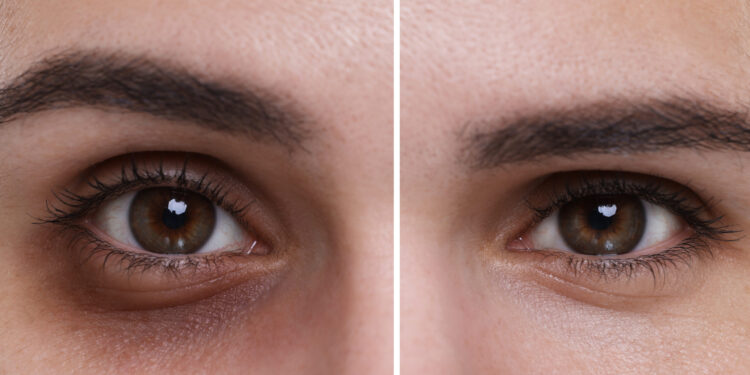 augenringe in 1 minute weg